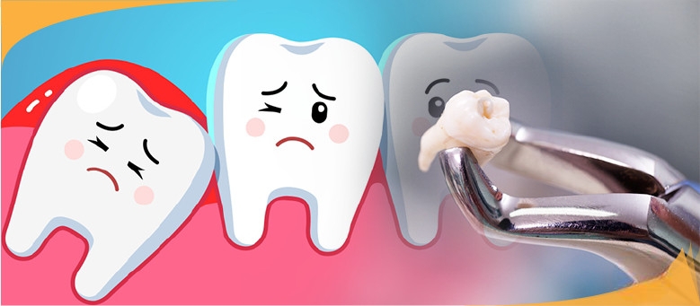 Có nên nhổ bỏ răng khôn không?