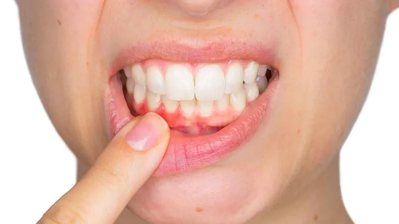 Bệnh viêm nướu răng hay viêm nha chu?